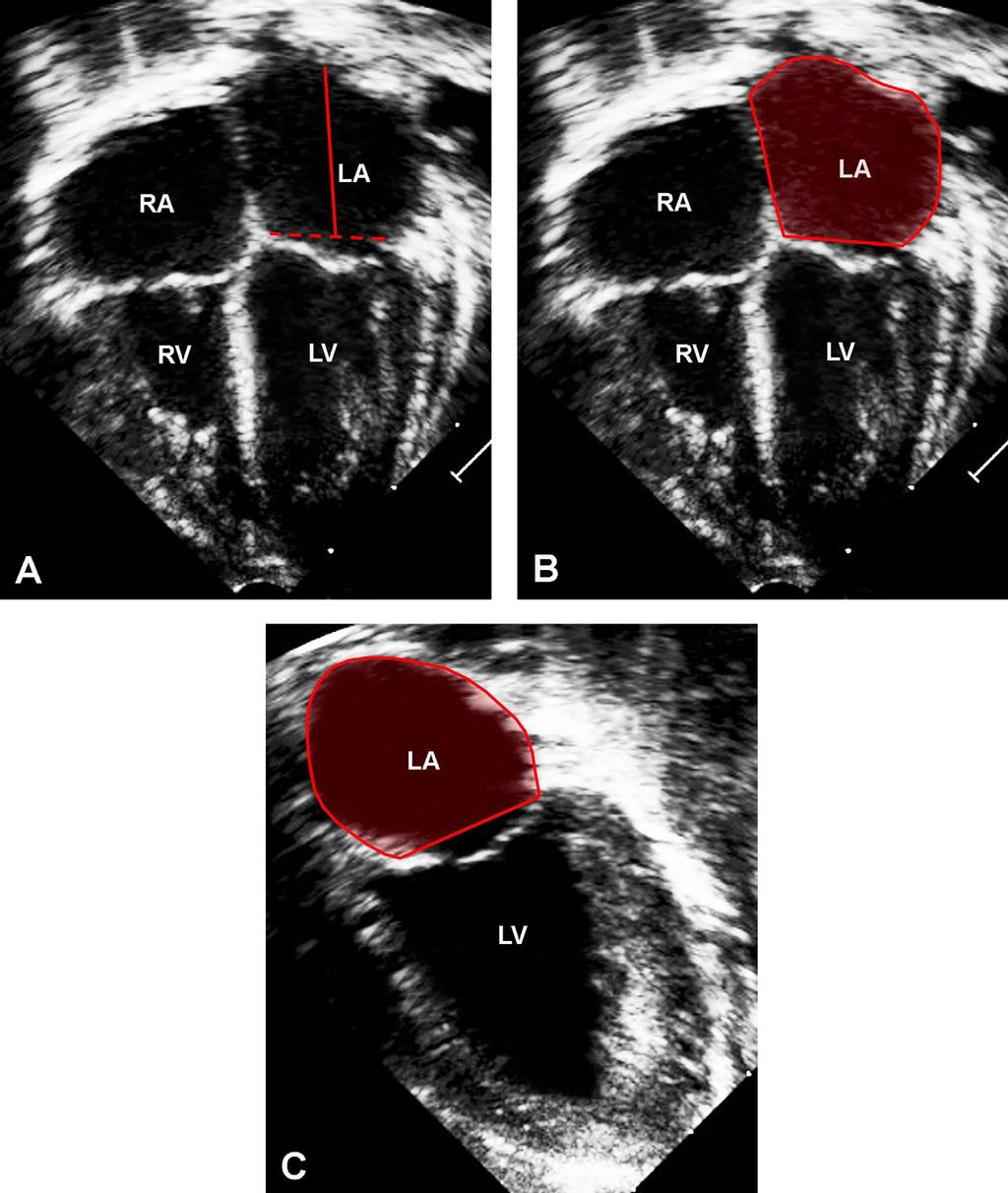 Figura 1 Apical 4-câmaras e 2-câmaras no final da sístole ventricular demonstrando (A) comprimento no eixo-maior do átrio esquerdo no apical 4-câmaras, (B) planimetria da área do LA (AE)