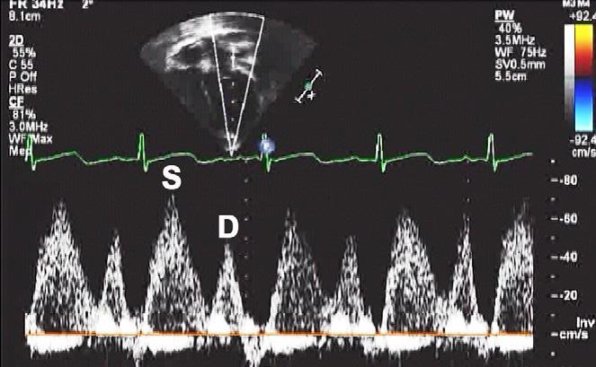 Figura 3 Padrão de fluxo venoso pulmonar ao Doppler.