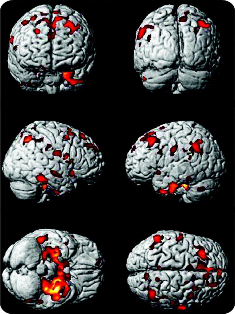 Exemplo de aprendizado supervisionado Predição de Alzheimer x i : imagem da