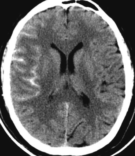 17 2.4 HEMORRAGIA SUBARACNOÍDEA (HSA) A HSA não traumática é uma emergência neurológica caracterizada pelo extravasamento de sangue no espaço preenchido por líquido cefalorraquidiano (LCR) e