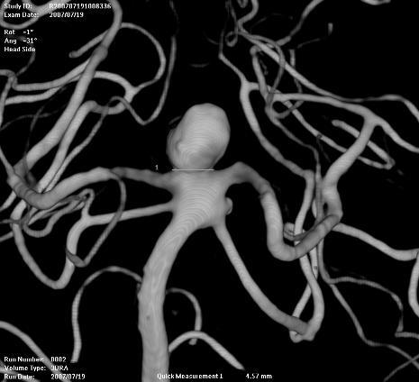 22 A B C D E F FIGURA 4: EMBOLIZAÇÃO DE UM ANEURISMA SACULAR DE TOPO DE ARTÉRIA BASILAR.