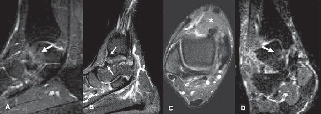 isointenso (meniscóide) na região ântero-medial do tornozelo (asterisco) e ainda mínima irregularidade na face medial do tálus com discreto edema na medular óssea em correspondência (setas espessas),