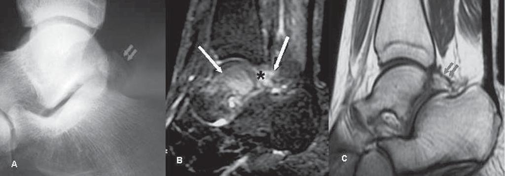 Há também edema na medular óssea e nas partes moles da porção posterior do tálus (setas longas), entre a borda posterior da epífise tibial e o os trigonum (asterisco).