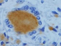 Método estreptavidina ligada à peroxidase, cromógeno DAB: Obj. 10x. Detalhe: célula gigante e macrófago epitelioide com marcação positiva.
