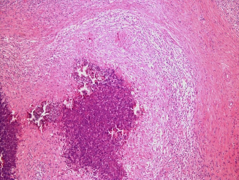 25 Dos suínos, foram diagnosticados 57 casos de linfadenite granulomatosa.