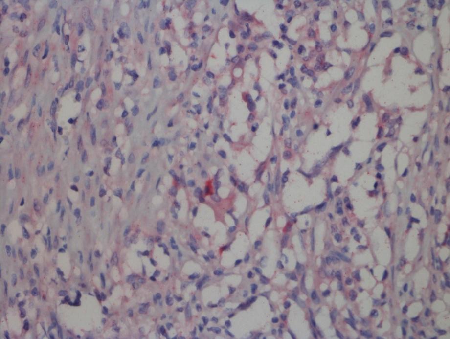12). Figura 11. Linfadenite granulomatosa em suíno. Marcação positiva de linfócitos T (anti-cd3). Método da estreptavidina ligada à fosfatase alcalina, cromógeno Permanent Red: Obj. 40x. Figura 12.