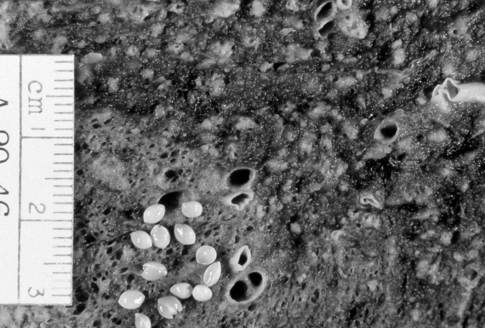 Granuloma infeccioso distribuição randômica bronquiolocentricidade (?) isolados (pouca coalescência) inflamação adjacente Tuberculose.