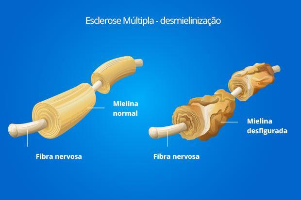 Definição Doença crônica, inflamatória e degenerativa do Sistema