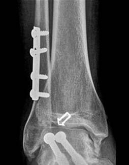 SEQUELAS A LONGO PRAZO DE FRACTURAS DO CORPO E COLO DO ASTRáGALO 435 Um achado curioso foi a da diferença entre os resultados das fracturas do colo (AOFAS médio: 61) e as do corpo (AOFAS médio: 82).