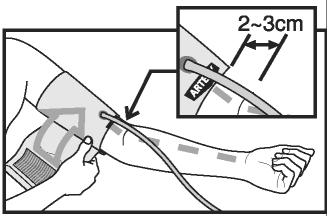 A borda da braçadeira deve ficar 2-3 cm acima da dobra do cotovêlo. O dizer <ARTERY> deve estar sobre a artéria do braço. 4.