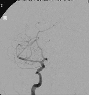 Intracranial