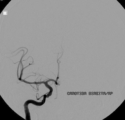 Intracranial Estenose