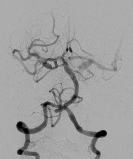 Intracranial