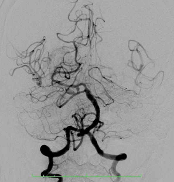 - Endovascular -