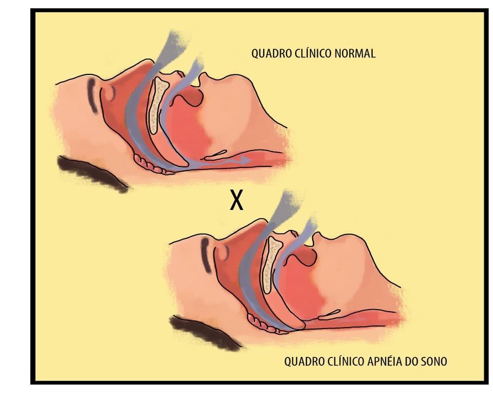 10 2.8 EXERCÍCIO CLÍNICO 08 O Sr. P.D.P, 75 anos, obeso, casado, procura o otorrinolaringologista a pedido da esposa. Ela reclama que o marido ronca a noite inteira e atrapalha seu sono.