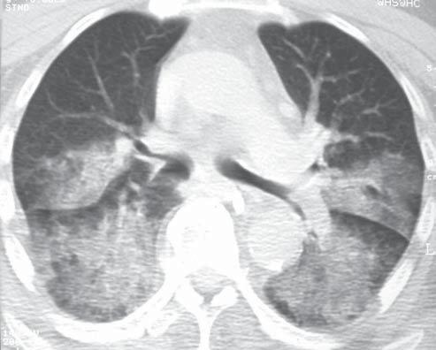 Pneumonia lipoídica em adultos: aspectos na TCAR A Figura 3.