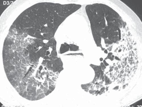 Marchiori E et al. Figura 6. Extensas áreas com padrão de pavimentação em mosaico localizadas em ambos os pulmões. Notar também dilatação do esôfago, com nível líquido (megaesôfago).