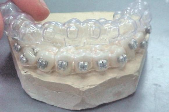 FIGURA 1 - Fixação dos dentes naturais,