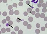 3) PARASITAS E ALTERAÇÕES DE PLAQUETAS PARASITAS E