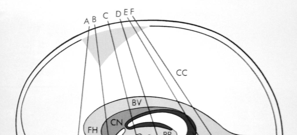 20 Casuística e Método Figura 4. Planos da ultra-sonografia cerebral coronal através da fontanela anterior.