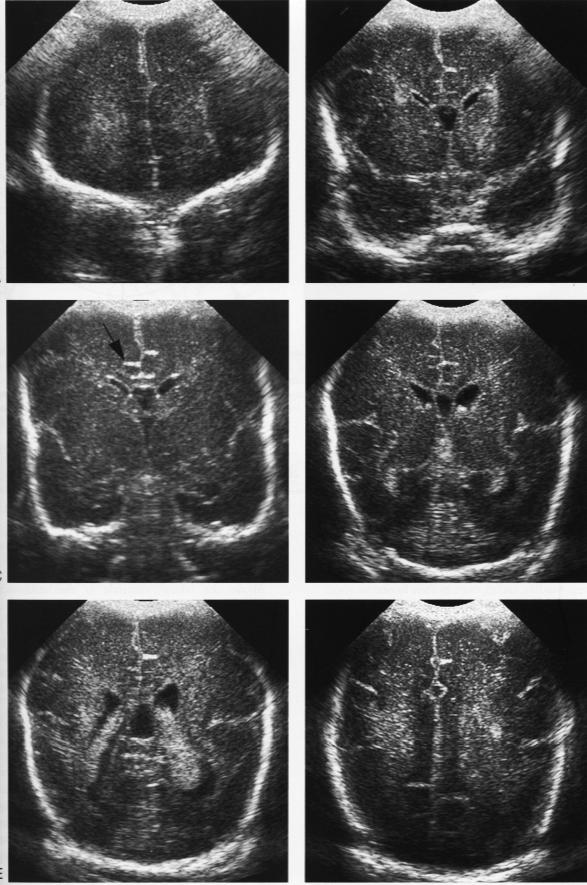 21 Casuística e Método A B C D E F Figura 5. Ultra-sonografias cerebrais coronais de neonato prematuro normal.