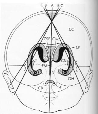 22 Casuística e Método Os planos da ultra-sonografia cerebral sagital através da fontanela anterior estão nas Figuras 6 a 8.