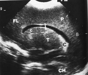 lateral; corno occipital (OH);corno temporal (TH); fissura silviana (SF); tálamo (T); cerebelo (CB); plexo coróide (CP); B-Ultrasonograma sagital, tomada paramediana.