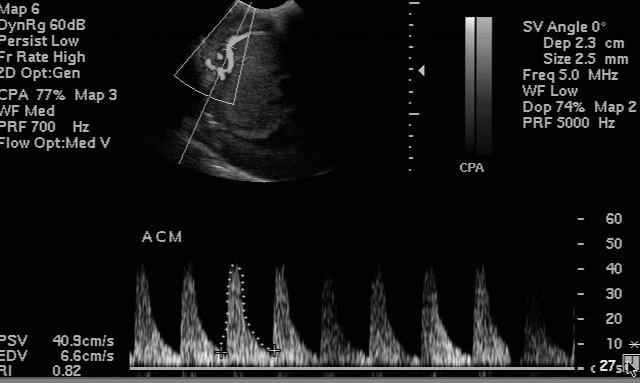 corte sagital leucomalácia