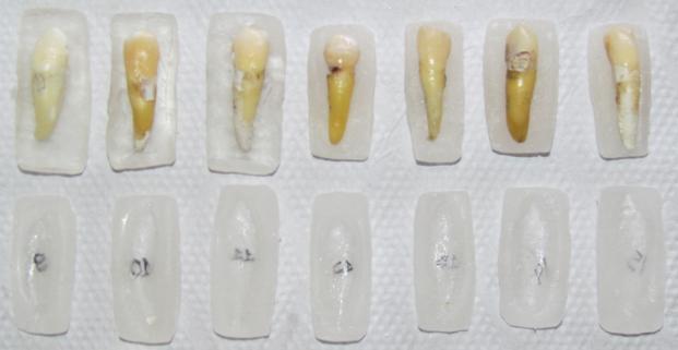 17 Após avaliação criteriosa da topografia e anatomia interna do sistema de canais radiculares através das radiografias de estudo, nove dentes foram excluídos por apresentarem tratamento endodôntico