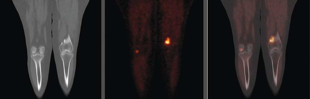 Corte coronal de PET com 18 F-NaF (C) mostra hipercaptação focal na mesma região, suspeita para acometimento secundário.
