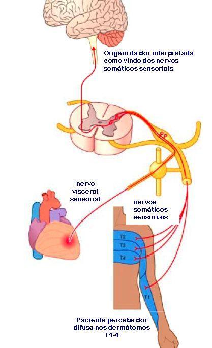 Sensações Viscerais Dor Referida: definida e mal localizada Geralmente são percebidas como originadas pela parede do corpo ou