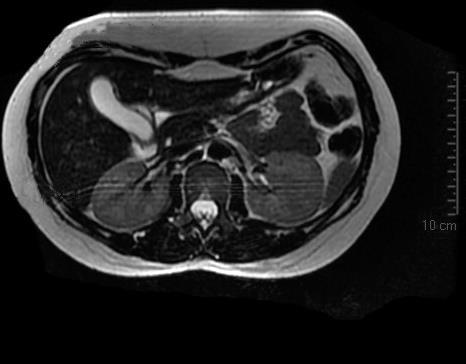 T2 FAT-SAT 1 US INCONCLUSIVO RM