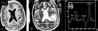 aumentado como o tumor aparecem com aspecto branco, sendo melhores do que imagens de TC contrastadas (LUCENA, 2005). Figura 2: Tumor Astrocitário de IV grau - sequências em axial RM.