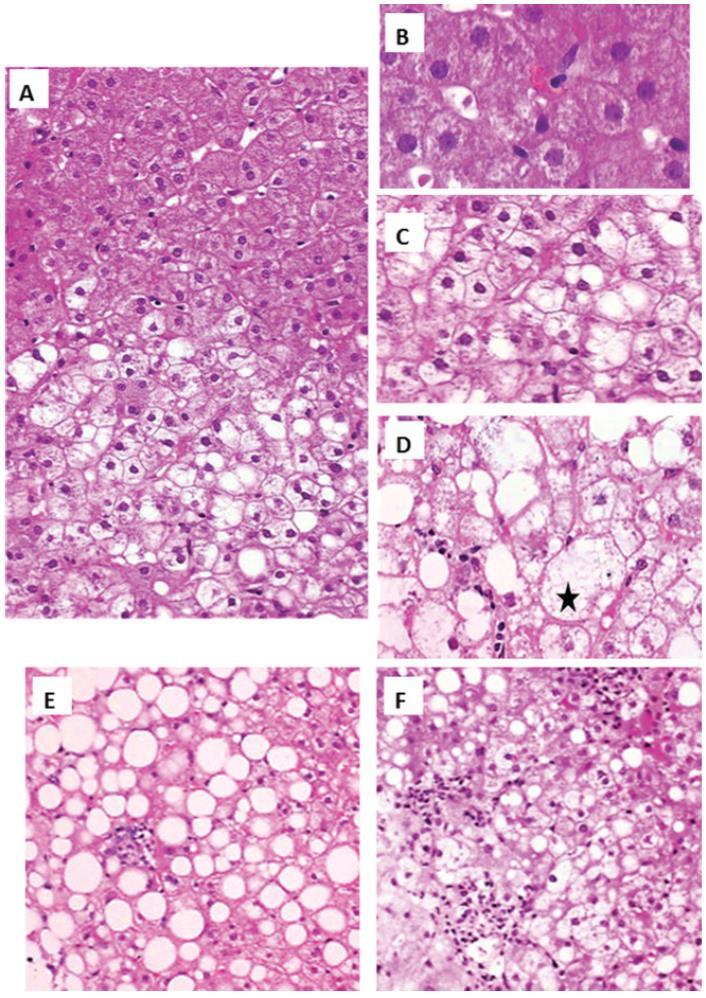 claros, grandes (2x tamanho normal) Inflamação: 0- ausente 1- < 2 focos campo de 20x 2- > 2 focos campo de 20x Graus de atividade: A0= 0,