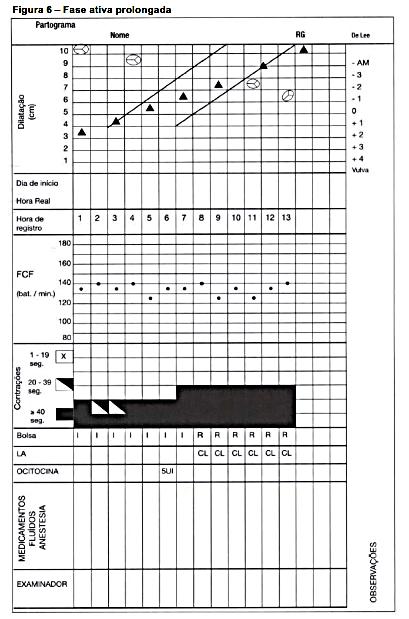 PARTOGRAMA (OMS) FASE ATIVA PROLONGADA Dilatação do colo mais lenta (1 cm/hora) Contrações
