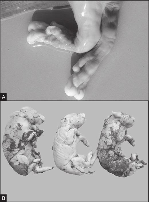 1062 Caroline A. Pescador et al. Fig.6. Feto suíno abortado. (A) Fígado normal. (B) Fígado amarelado e friável em processo de autólise. Fig.5. Feto suíno abortado. (A) Membros anteriores demonstrando a presença de apêndice decidual.