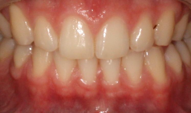 REVISÃO DA LITERATURA 28 B Ilustração 5. Coincidência e não coincidência das linhas médias dentárias superior e inferior.