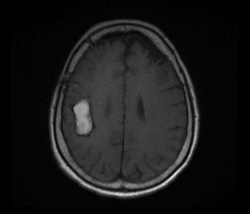 Introdução A doença de moyamoya (DMM) é uma desordem cerebrovascular de rara incidência, caracterizada pela estenose e oclusão progressiva das porções terminais das artérias carótidas internas e seus