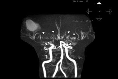 3 Além da estenose progressiva, observa-se nessa patologia o desenvolvimento de uma rede de vasos colaterais anormalmente dilatados na base do crânio, que podem assumir um aspecto de fumaça, cujo