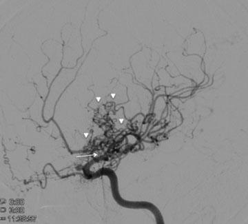 Fig. 3 Imagens de angiografia digital por subtração incidência anteroposterior mostrando estenose grave do segmento supraclinoide das artérias carótidas internas e seus ramos terminais (artérias