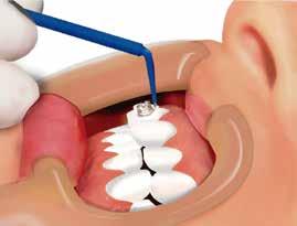 ATENÇÃO: Não use resinas de restauração no lugar de adesivos para colagem, pois são mais densas, penetram menos na base da peça ortodôntica e dificultam a remoção do dente.