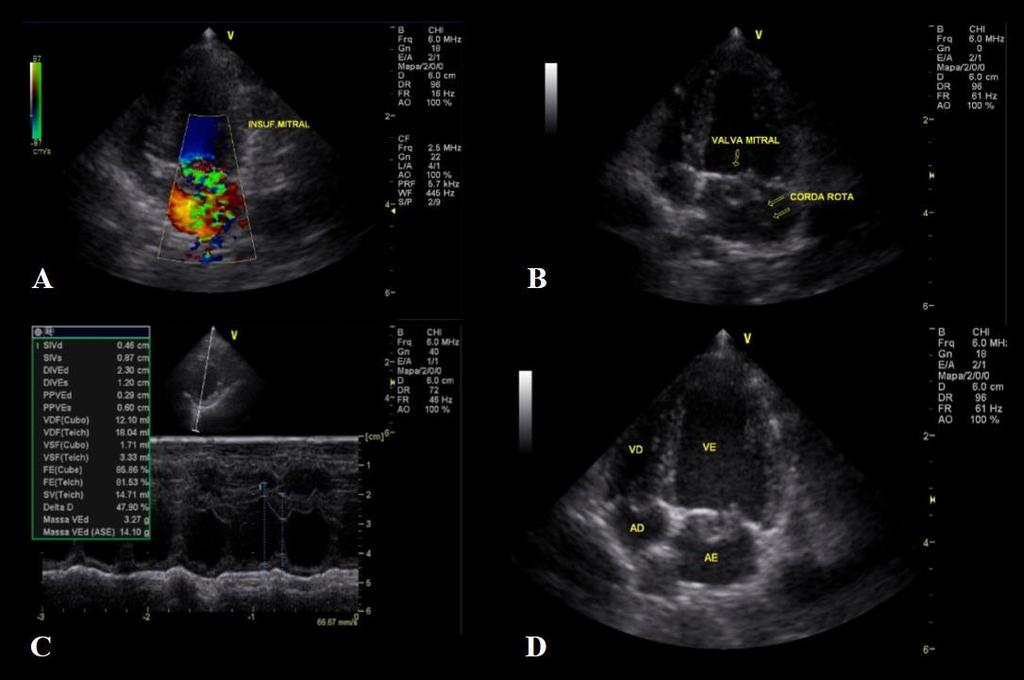 Além disso, observou-se hipertrofia excêntrica do ventrículo esquerdo de grau discreto a moderado característico da sobrecarga de volume.