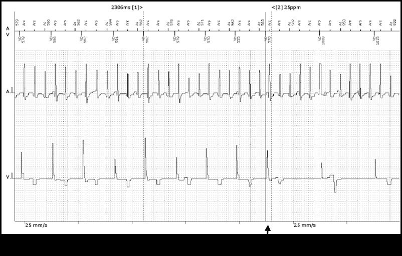 Material e Métodos 28 LEGENDA: MAM= mudança automática de modo. Figura 5. Eletrograma intracavitário compatível com fibrilação atrial.