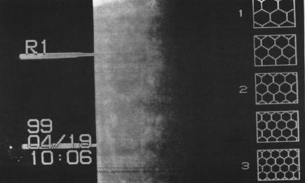 Síndrome de Cogan-reese: relato de um caso Figura 3: Microscopia especular do olho direito, apresentando diminuição importante do número de células, com alterações endoteliais caractrerísticas.