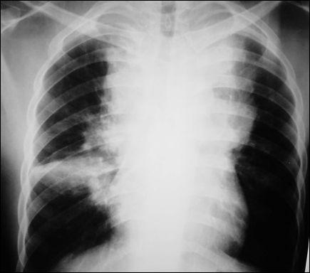 tumores de esôfago, megaesôfago, cistos broncogênicos, tumores traqueais, mediastinite fibrosante, aneurismas vasculares, linfoma (figura 7), hérnia