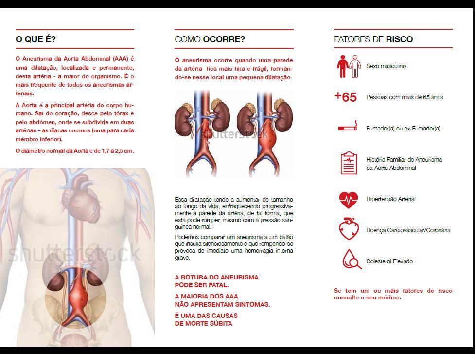 O Aneurisma mais frequente O Aneurisma da Aorta Abdominal (AAA) é o mais frequente de todos os aneurismas arteriais. Não apresenta sintomas na maioria dos casos.