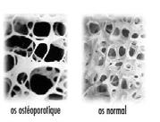 Tratamento com suprimento adequado de cálcio e fosfato na dieta associado a administração de vitamina D OSTEOPOROSE Decorre da diminuição da matriz orgânica do osso e não da calcificação óssea