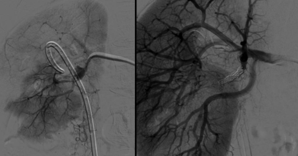 202 I. Antunes et al. Figura 1 Doente 3, angiografia antes e após embolização de FA em ramo da artéria renal direita.