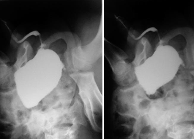 Acta Urológica 2006, 23; 4: 41-46 Válvulas da uretra posterior: Casuística do Serviço de Urologia do Hospital Maria Pia 43 Fig.