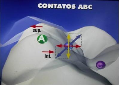 20 FIGURA 4-Decomposição da força de oclusão em vetores axiais (amarelo) e horizontais (vermelho) do contato B. (Imagens cedidas por Dr.